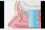 Relieva Sinus Spacer will allow medciaiton to bathe the sinus.